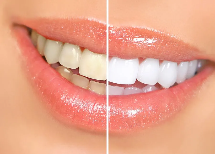 teeth whitening jammu jammu